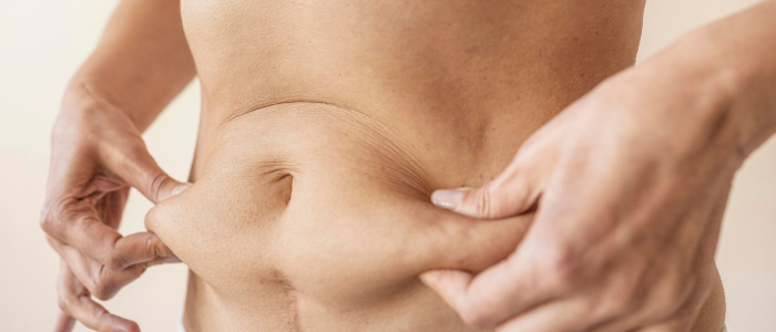 tummy tuck surgery in Hyderabad